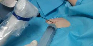 La Crioablazione al “Bonomo” di Andria per il trattamento dei noduli mammari