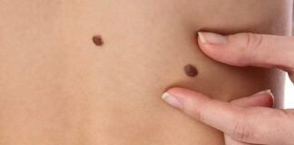 Meeting sul “melanoma cutaneo maligno, prevenzione e cure terapeutiche” il 14 dicembre ad Andria